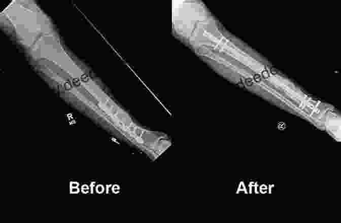 Malunion And Nonunion After Orthopedic Surgery Common Complications In Orthopedic Surgery An Issue Of Orthopedic Clinics (Volume 52 3) (The Clinics: Orthopedics Volume 52 3)